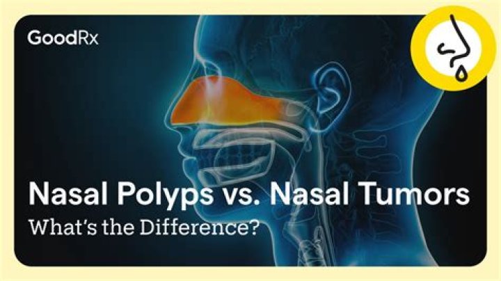 What's The Difference Between Nodules And Polyps?